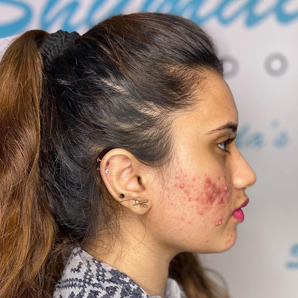 Acne Treatment In London Acne Treatment Options Shumaila S