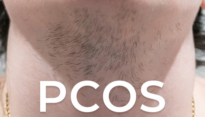 PCOS Facial Hair Why it Happens and How to Deal With It